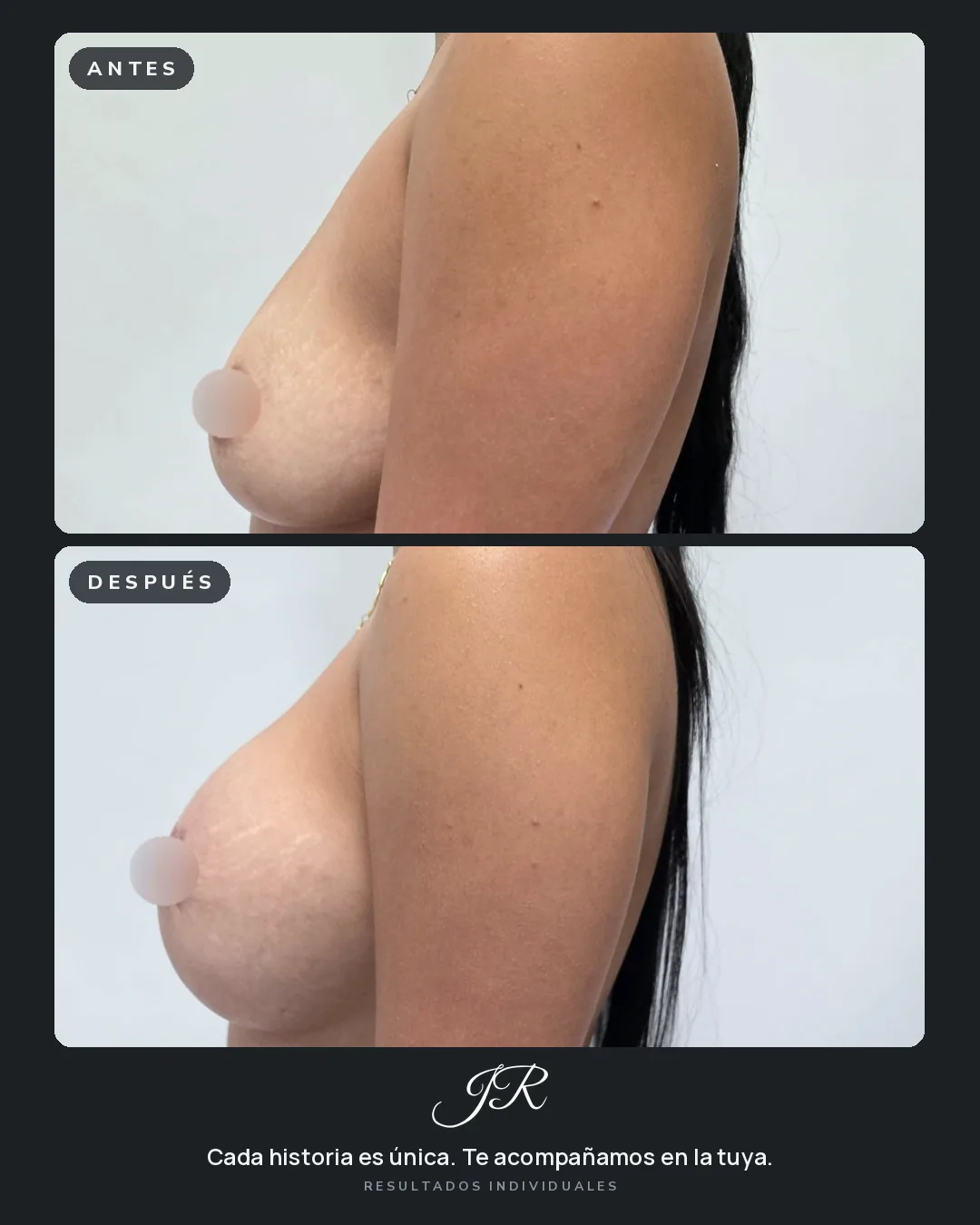 Comparativa antes y después de cirugía de mama, vista lateral de la misma paciente