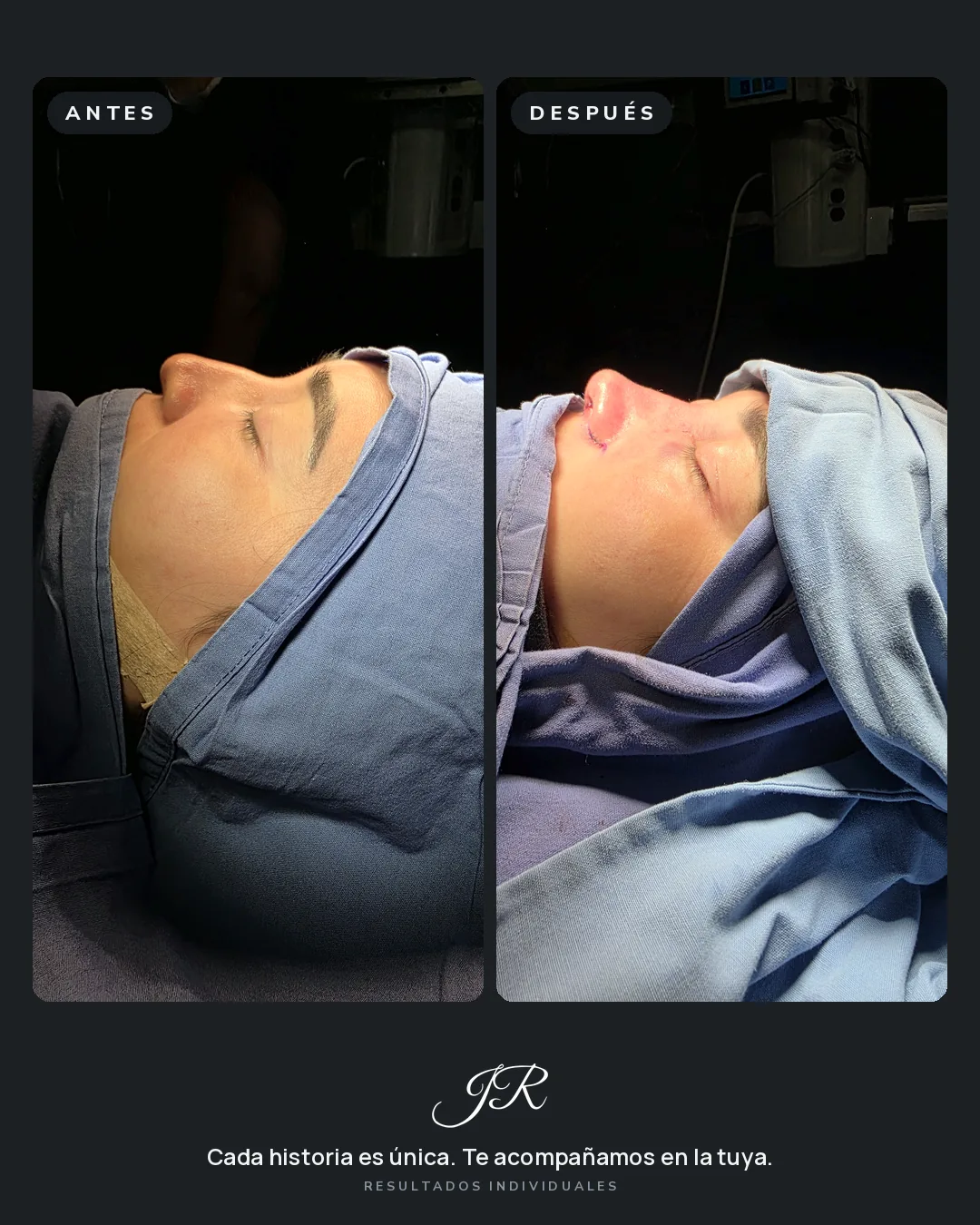 Comparativa antes y después de rinoplastia, vista lateral de una paciente