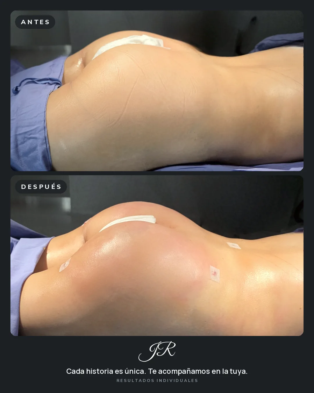 Comparativa antes y después de lipoescultura, vista lateral de la zona glútea