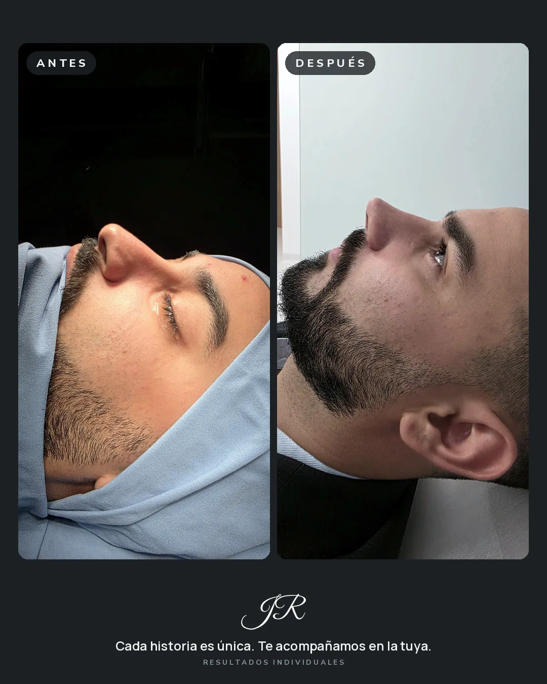 Comparativa antes y después de rinoplastia, vista lateral de un paciente