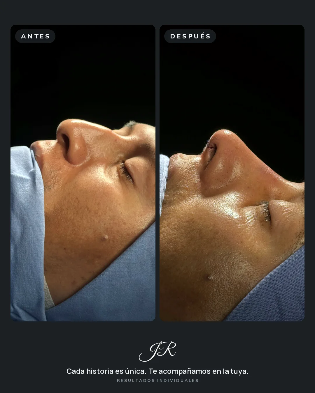 Comparativa antes y después de rinoplastia, vista lateral de una paciente